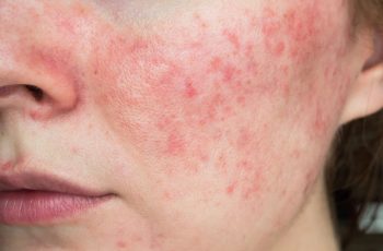 What Does Azelaic Acid Do for Rosacea?