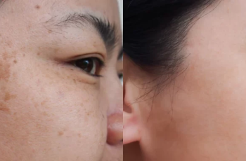 How to Get Rid of Dark Spots on Face?