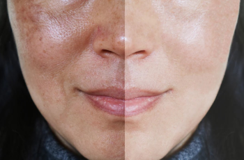 How Can You Reduce Enlarged Pores?