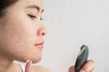 Skincare After Sunburn: Should You Use Azelaic Acid?