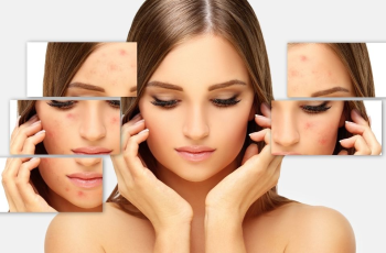 Understanding Lactic Acid and Skin Purging: A Skincare Guide Understanding Lactic Acid and Skin Purging: A Skincare Guide