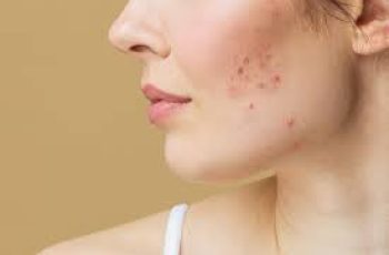 Comprehensive Guide to Understanding and Treating Cystic Acne