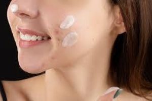 Treating Open Acne Spots Safely with Niacinamide in Skincare