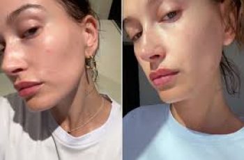Skincare Tips from Hailey Bieber for Perioral Dermatitis Relief