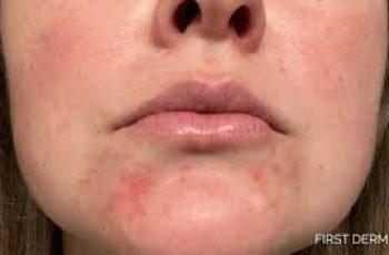 Dry Skin Around the Mouth: Causes, Prevention Tips, and Effective Treatments for Relief