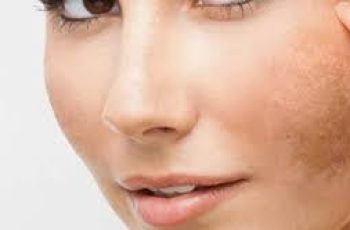 Treating Melasma From Within: Supplements, Skincare, and Lifestyle Tips Treating Melasma From Within: Supplements, Skincare, and Lifestyle Tips