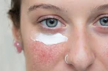Azelaic Acid for Rosacea: A Gentle Skincare Solution Guide Azelaic Acid for Rosacea: A Gentle Skincare Solution Guide