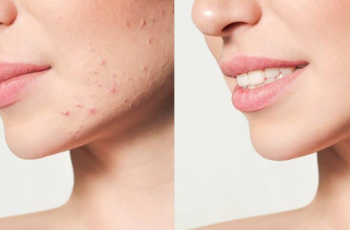 Fillers for Acne Scars: What You Need to Know Fillers for Acne Scars: What You Need to Know