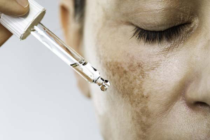 How Inflammation Triggers Hyperpigmentation—and What to Do About It